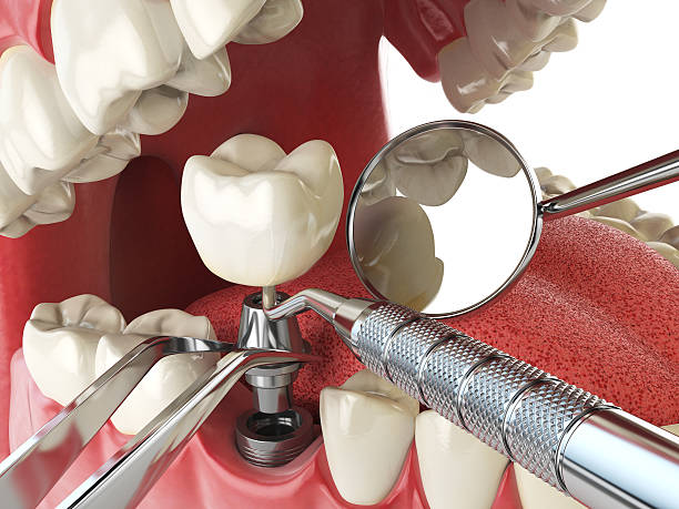 Best Knocked-Out Tooth Emergency  in Little Cypress, TX